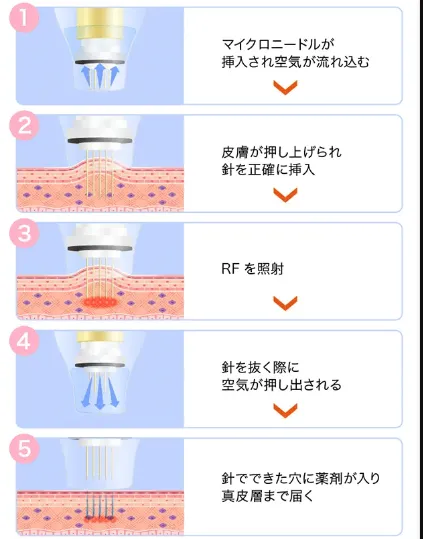 ポテンツァが安いおすすめのクリニックTCB 施術方法
