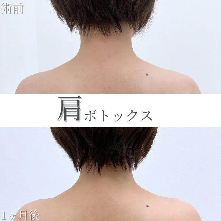 TCBの肩ボトックス　症例写真