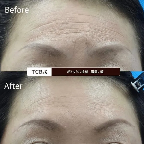 失敗のないTCBのボトックス注射の症例写真