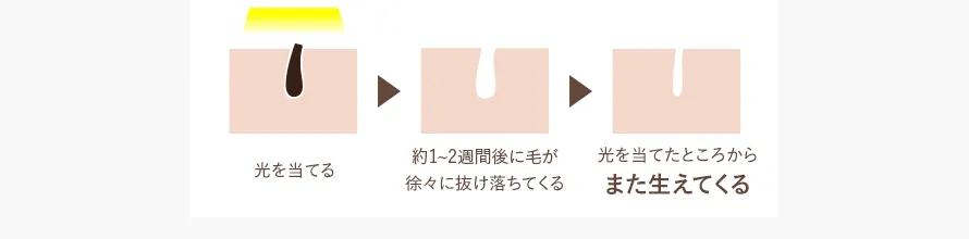 光脱毛の機序についての画像