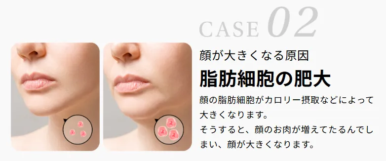 ディオクリニックの顔が痩せる方法における脂肪細胞の肥大画像