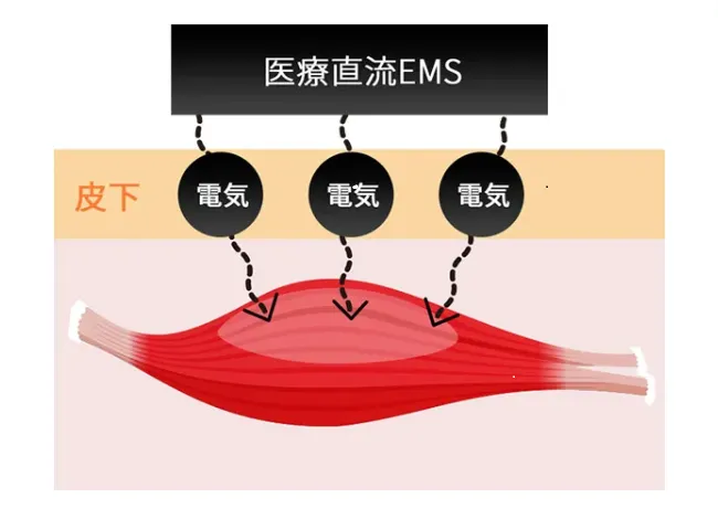 ディオクリニックの顔が痩せる方法4選のEMS画像