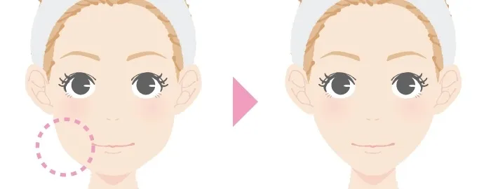 横浜でエラボトックスがおすすめのクリニック10選 エラボトックスの図