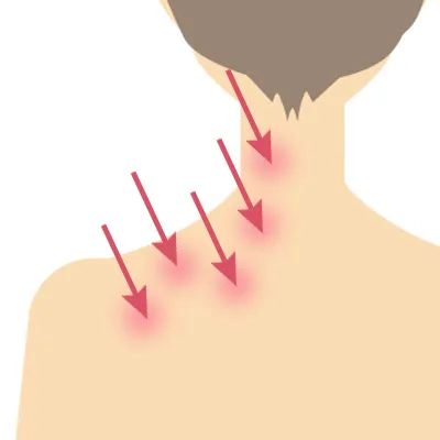TCB肩ボトックスはクーポン利用で無料？注射箇所
