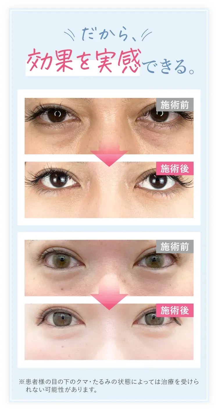 TCBのクマ取りの症例写真