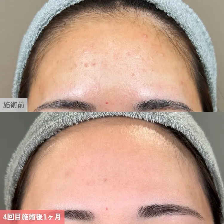 名古屋でポテンツァが安いおすすめのクリニック 症例写真