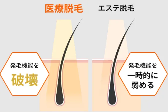 レジーナクリニックの医療脱毛とエステ脱毛の違い