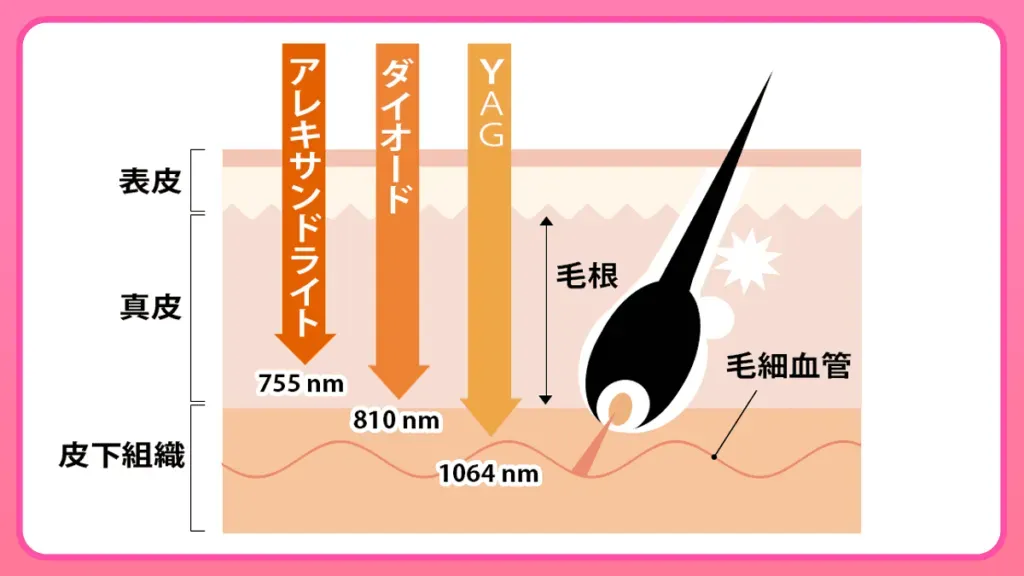 レジーナクリニック脱毛器ソプラノチタニウム