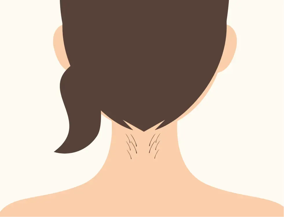 リゼクリニックは硬毛化の保証がある?専門家が徹底調査 硬毛化の場所
