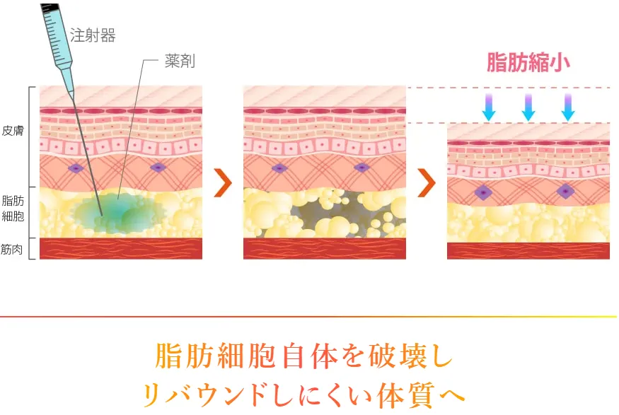 仙台で脂肪溶解注射がおすすめのクリニック|脂肪溶解注射イメージ画像