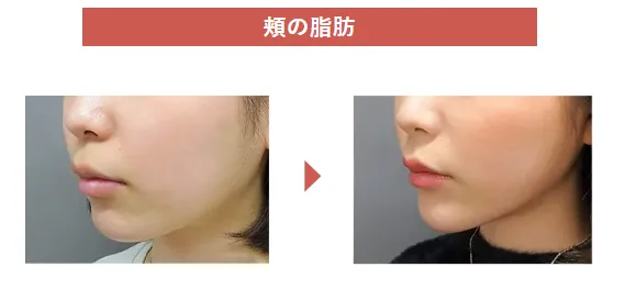 仙台で脂肪溶解注射がおすすめのクリニックの頬の施術画像