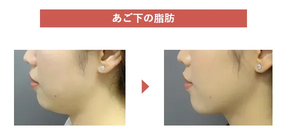 仙台で脂肪溶解注射がおすすめのクリニックのあご下の施術画像