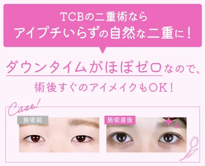 TCBの二重整形のダウンタイムはほぼなし