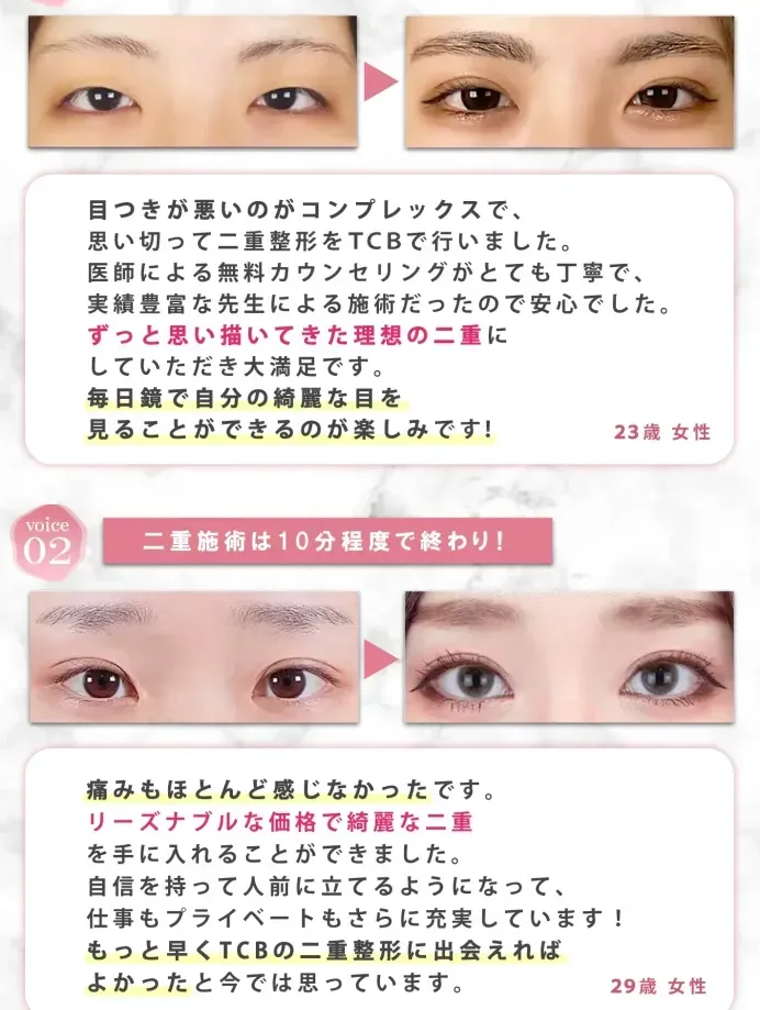 TCBの二重整形を受けた方の喜びの声