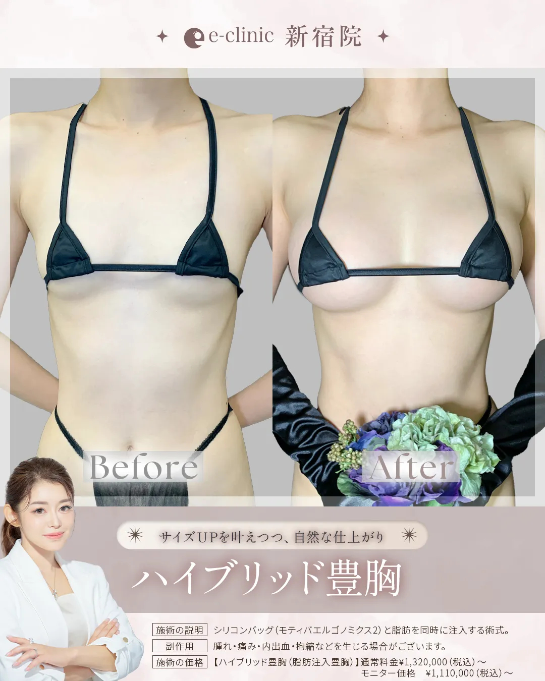 eクリニック田中里佳医師の症例画像ハイブリッド豊胸