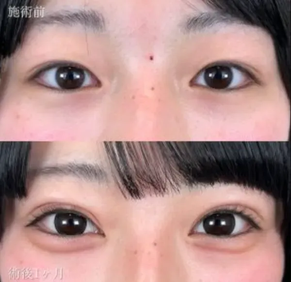 TCB二重整形の症例②19代以下の女性