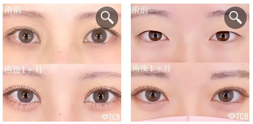 TCB二重症例①