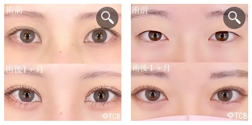 TCBの二重症例