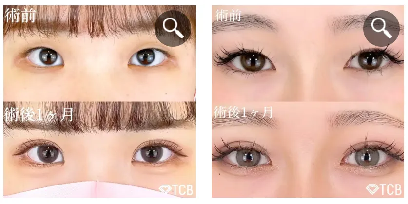 TCBの二重症例