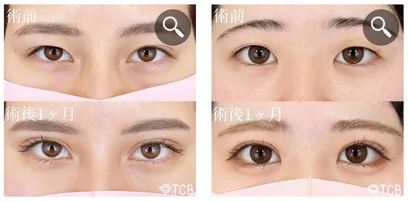 TCB二重症例②
