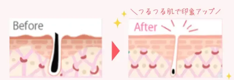 TBCの顔脱毛は、脱毛効果のみではなく美肌効果あり