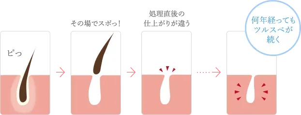 TBCの顔脱毛は何年経ってもツルスベ肌が続く