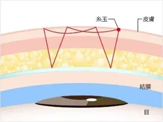 TCB二重術のダウンタイムは長い?ほぼゼロって本当?専門家が調査 術式⑤