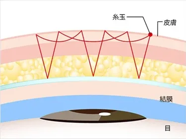 TCB二重術のダウンタイムは長い?ほぼゼロって本当?専門家が調査 術式⑥