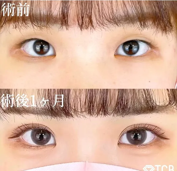 TCB二重術のダウンタイムは長い?ほぼゼロって本当?専門家が調査 症例写真