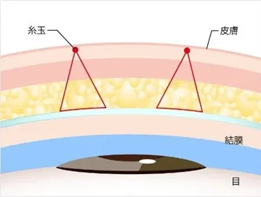 TCB二重術のダウンタイムは長い?ほぼゼロって本当?専門家が調査 術式②
