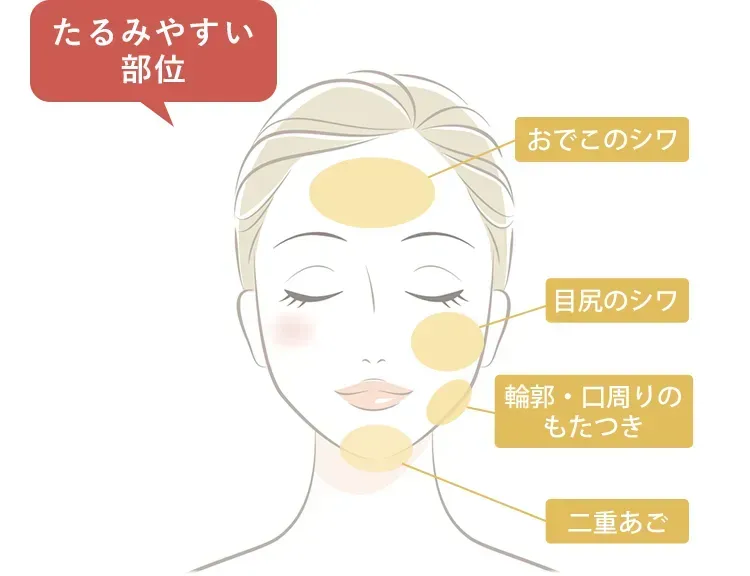 TCBハイフたるみやすい部位の絵