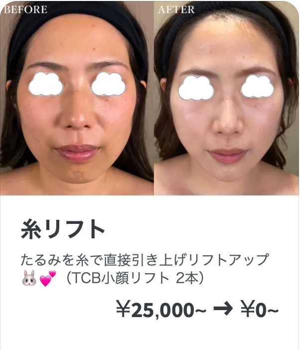 TCBの糸リフトのLINE画像
