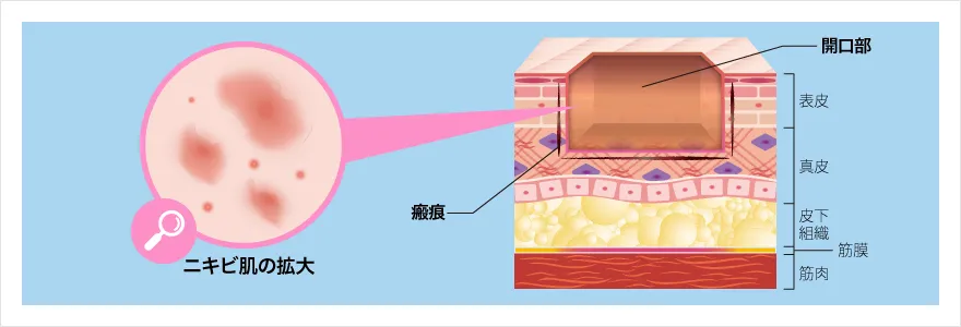 ニキビ跡ボックス型
