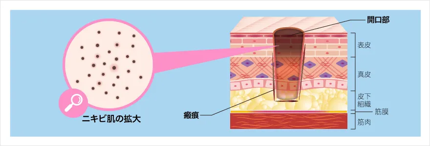 ニキビ跡アイスピック型