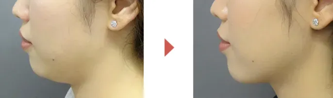 TCB脂肪溶解注射・症例写真・あご横顔