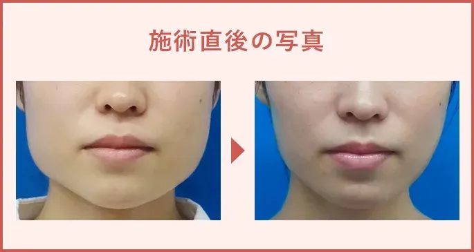 tcb脂肪溶解注射症例写真・正面頬とエラ