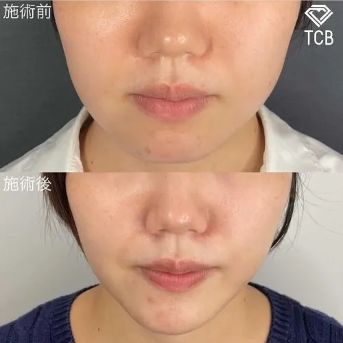 TCB村田大典医師の口コミ評判・経歴は?症例写真小顔整形1