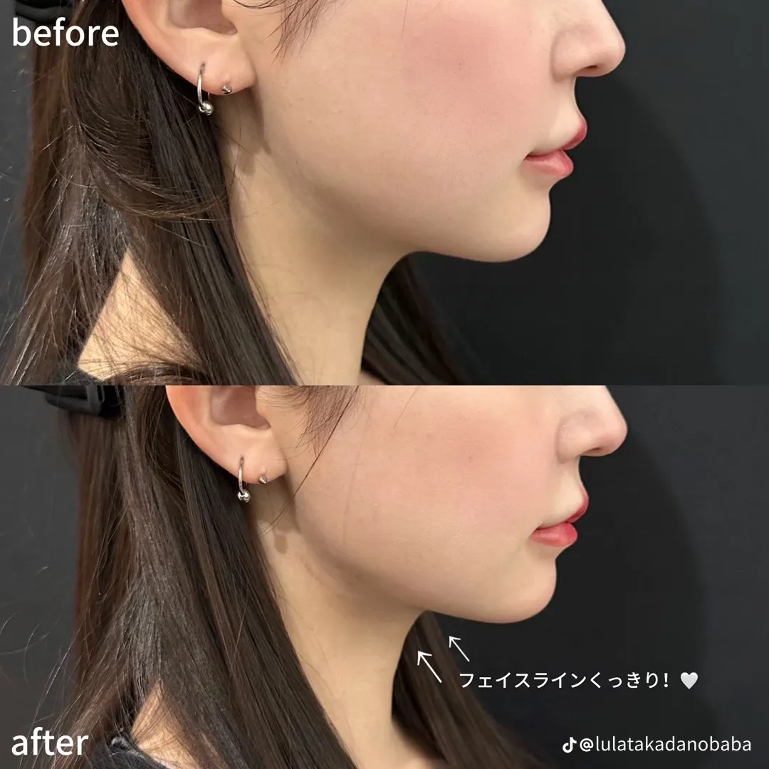 ルラ美容クリニックのインモード後のビフォーアフターを写真で見る