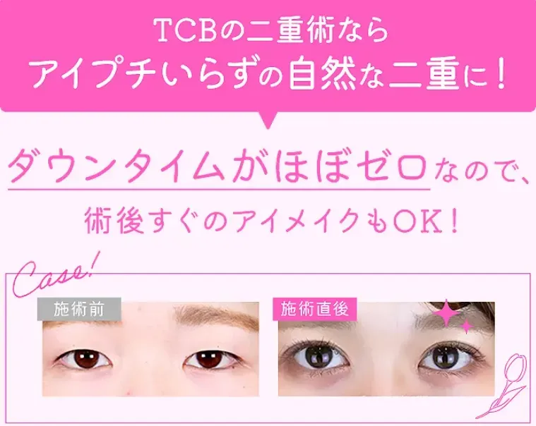 TCBの二重整形は傷跡が目立ちにくく自然な仕上がり
