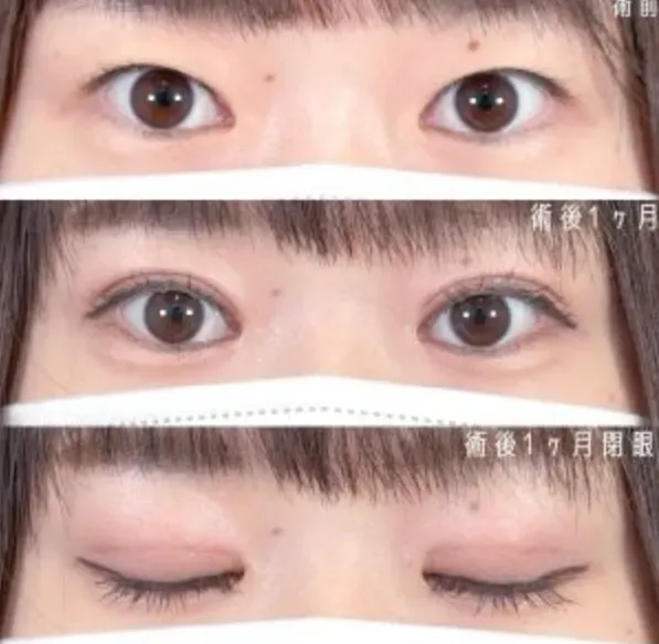TCB二重整形の症例①20代女性
