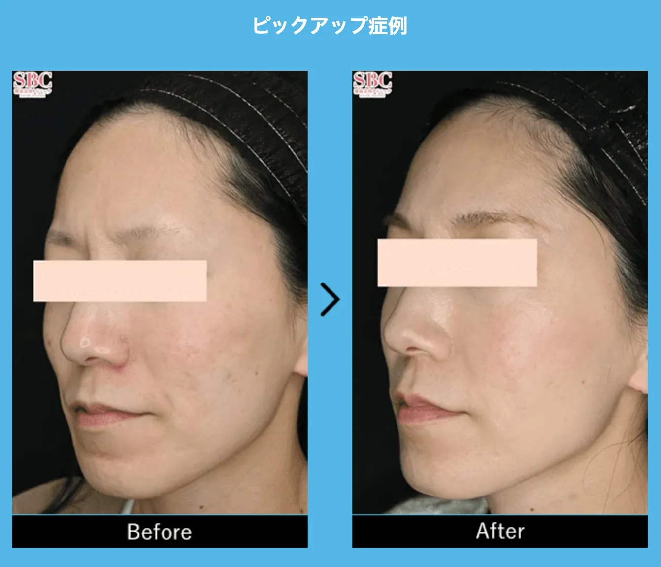湘南美容クリニックダーマペン4の症例写真