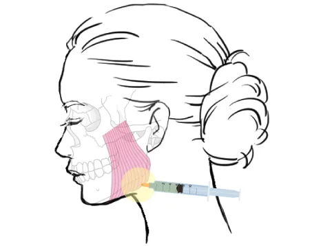 横浜でエラボトックスがおすすめのクリニック10選 咬筋の説明画像