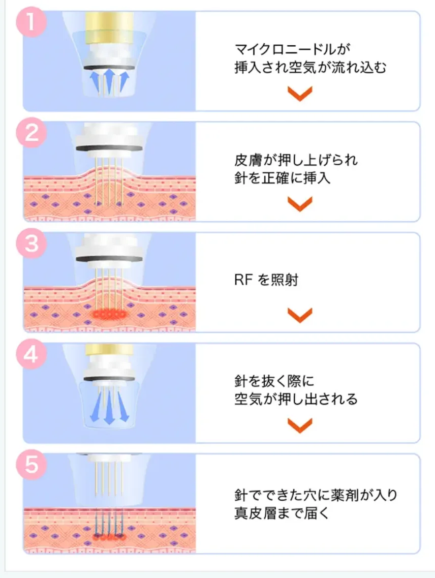 横浜でポテンツァが安いおすすめのクリニックであるTCBの施術内容