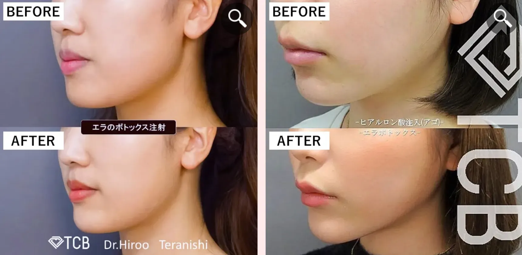 TCBの安すぎるボトックス施術の症例写真