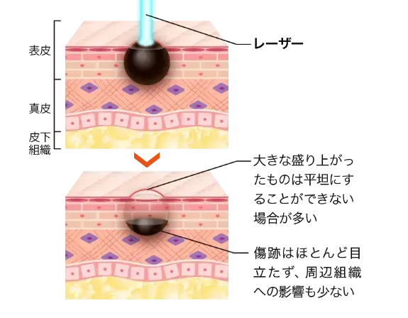 レーザー治療のイメージ画像