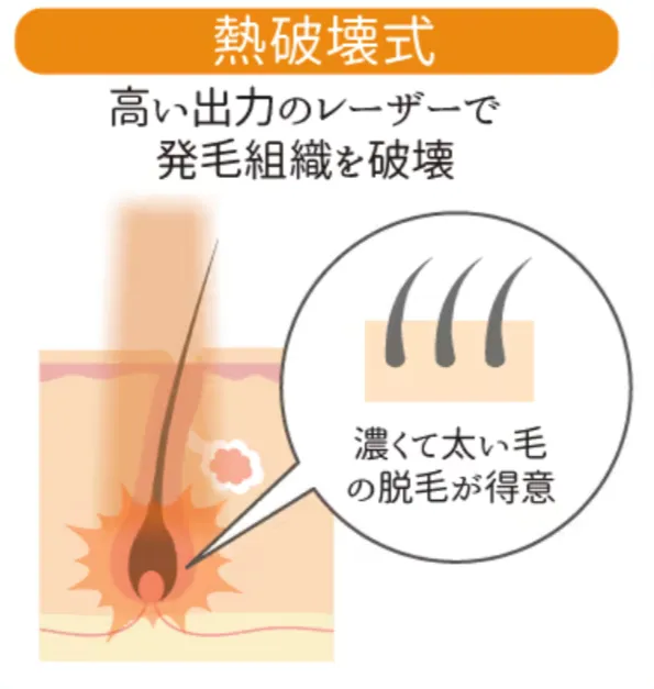 日暮里で都度払い医療脱毛が安いレジーナクリニックによる熱破壊式解説図