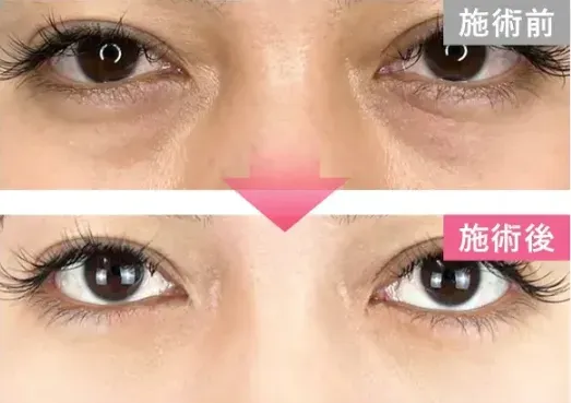 TCB　クマ取り症例写真