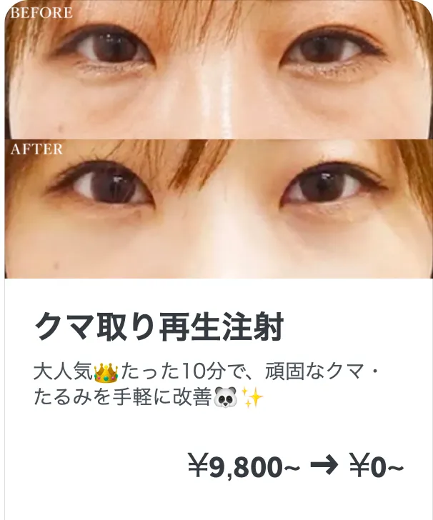 TCBのクマ取り再生注射 無料キャンペーンを