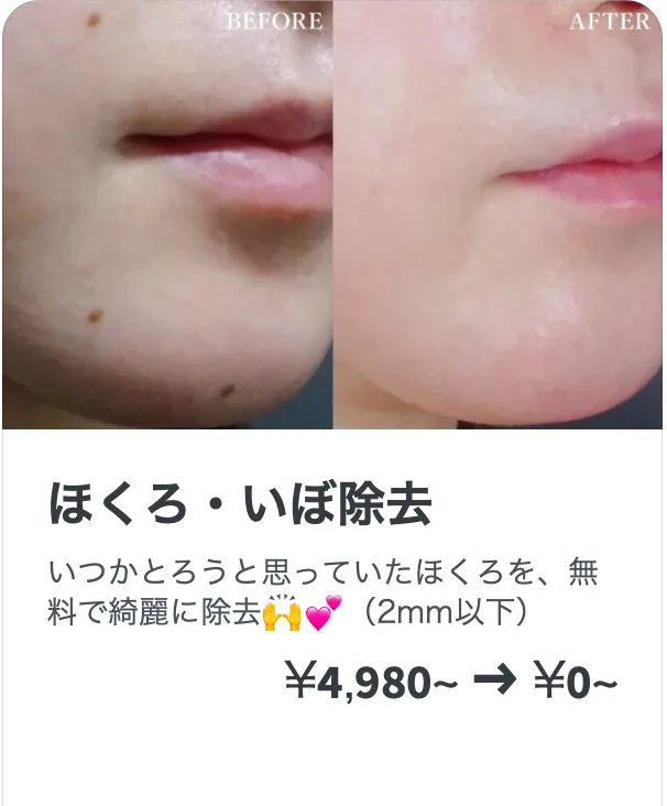 TCBのほくろ除去のキャンペーン価格