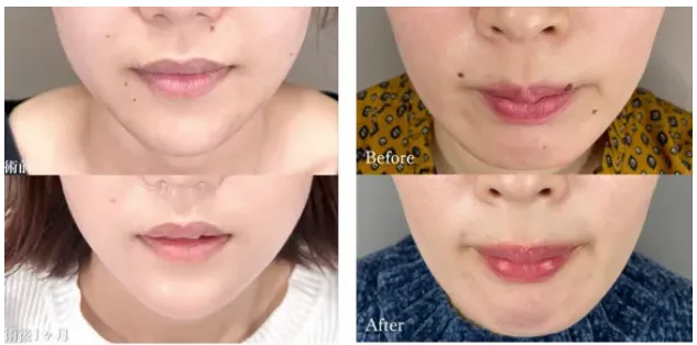 TCBのほくろ除去症例②